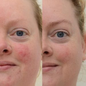 voor foto couperose behandeling, na foto couperose behandeling.