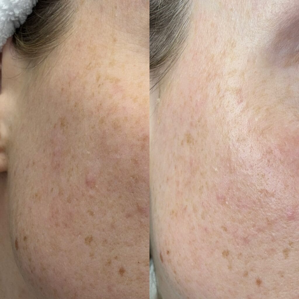 tca peeling voor en na